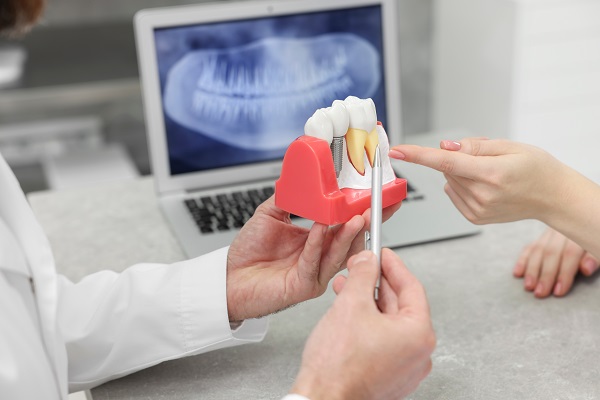 What Are The Advantages Of Getting Dental Implants